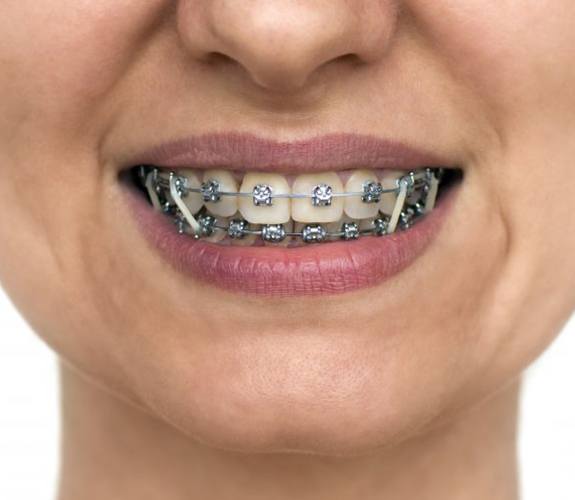 Girl with traditional braces in Sycamore