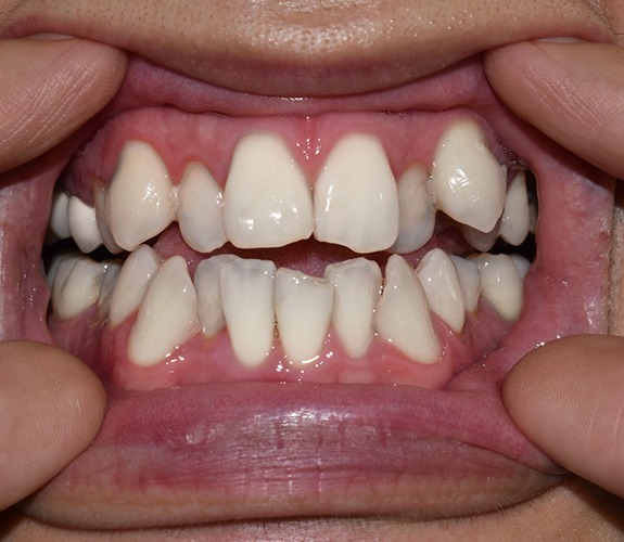 Person with crooked and crowded teeth