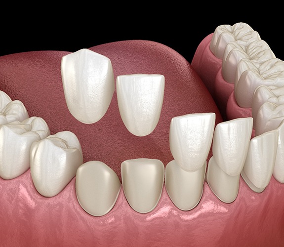 Digital view of dental veneers