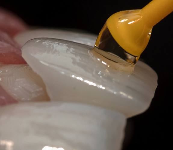 Dentist placing dental veneers