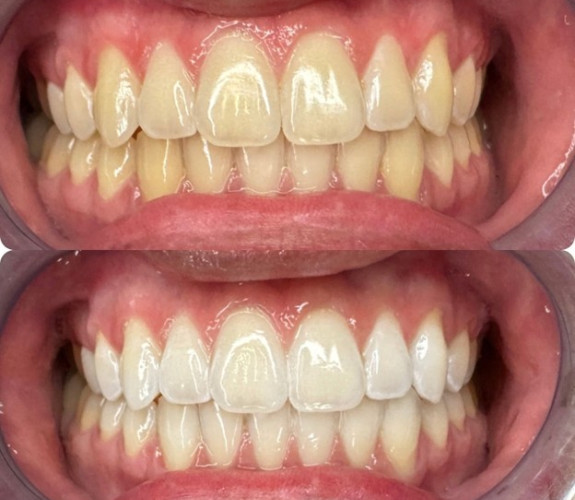 Before and after image of stained and whiter teeth